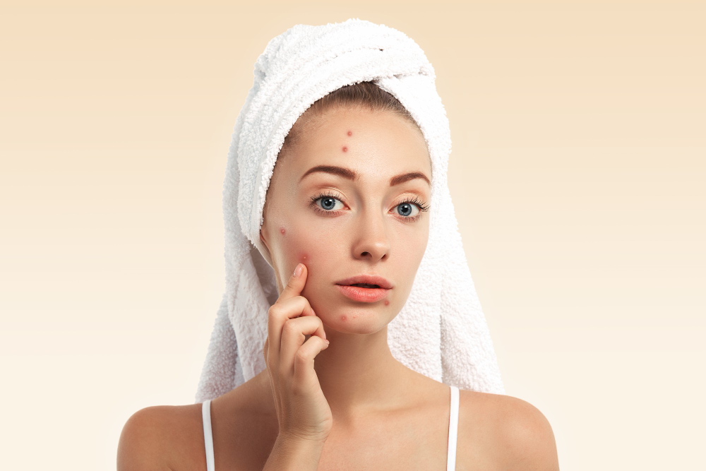 Top 10 Acne Prevention Tips Backed by Science